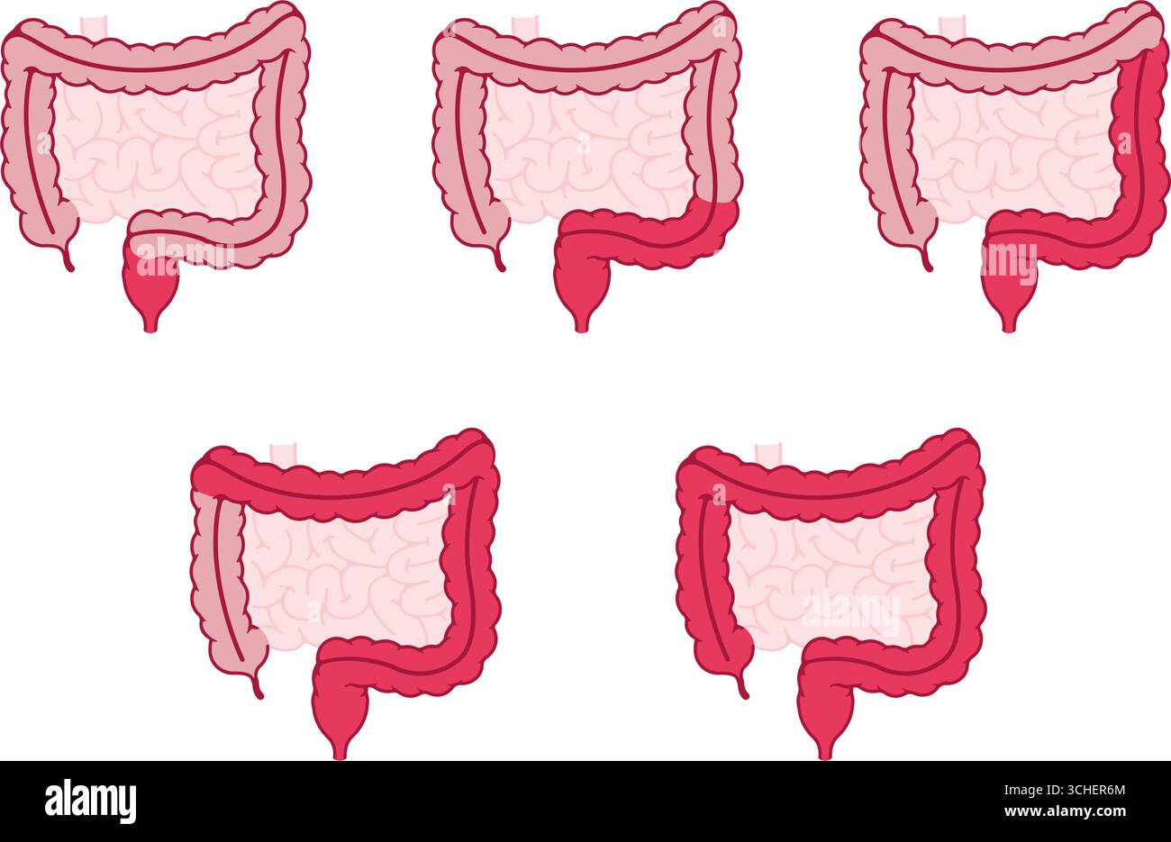 Tipi di colite ulcerosa. Illustrazione vettoriale Illustrazione Vettoriale