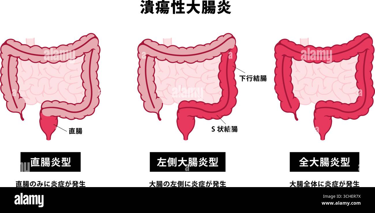 Tipi di colite ulcerosa. Illustrazione vettoriale Illustrazione Vettoriale