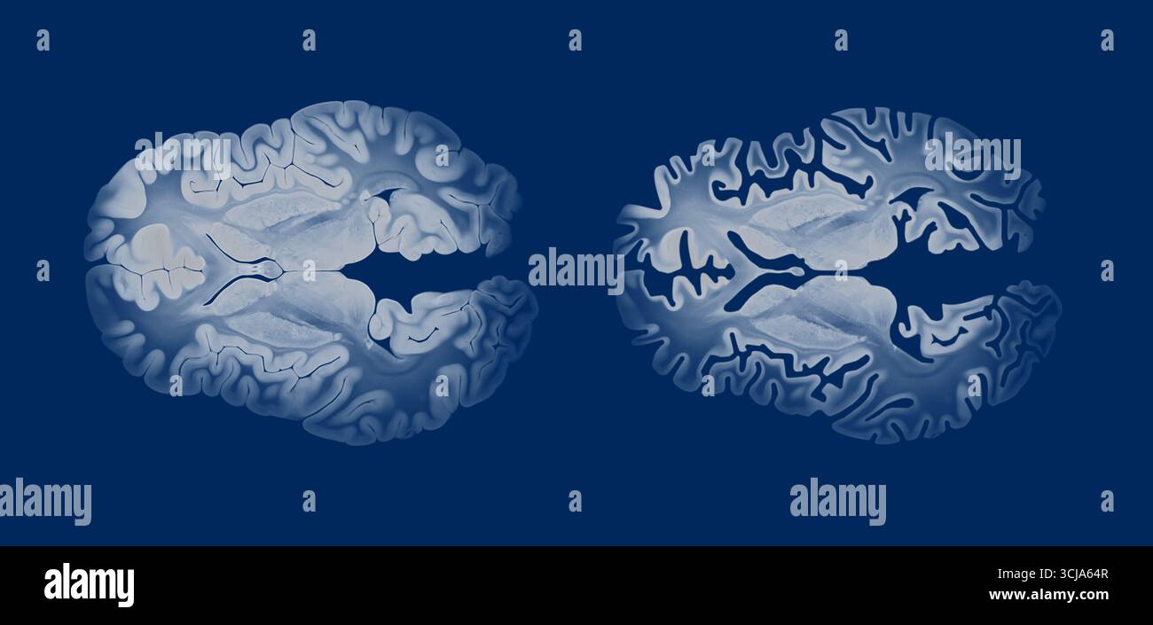 Confronto cerebrale Alzheimer in vista assiale che mostra differenze strutturali tra un cervello sano e affetto, evidenziando atrofia corticale e neurod Foto Stock