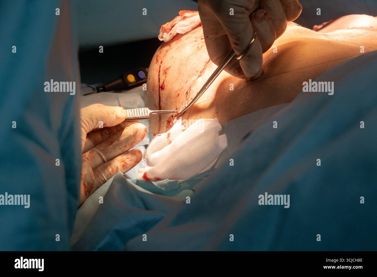 Infermiere di sala operatoria che assiste in una procedura chirurgica, offre un supporto critico gestendo gli strumenti e garantendo che l'ambiente chirurgico rimanga s Foto Stock