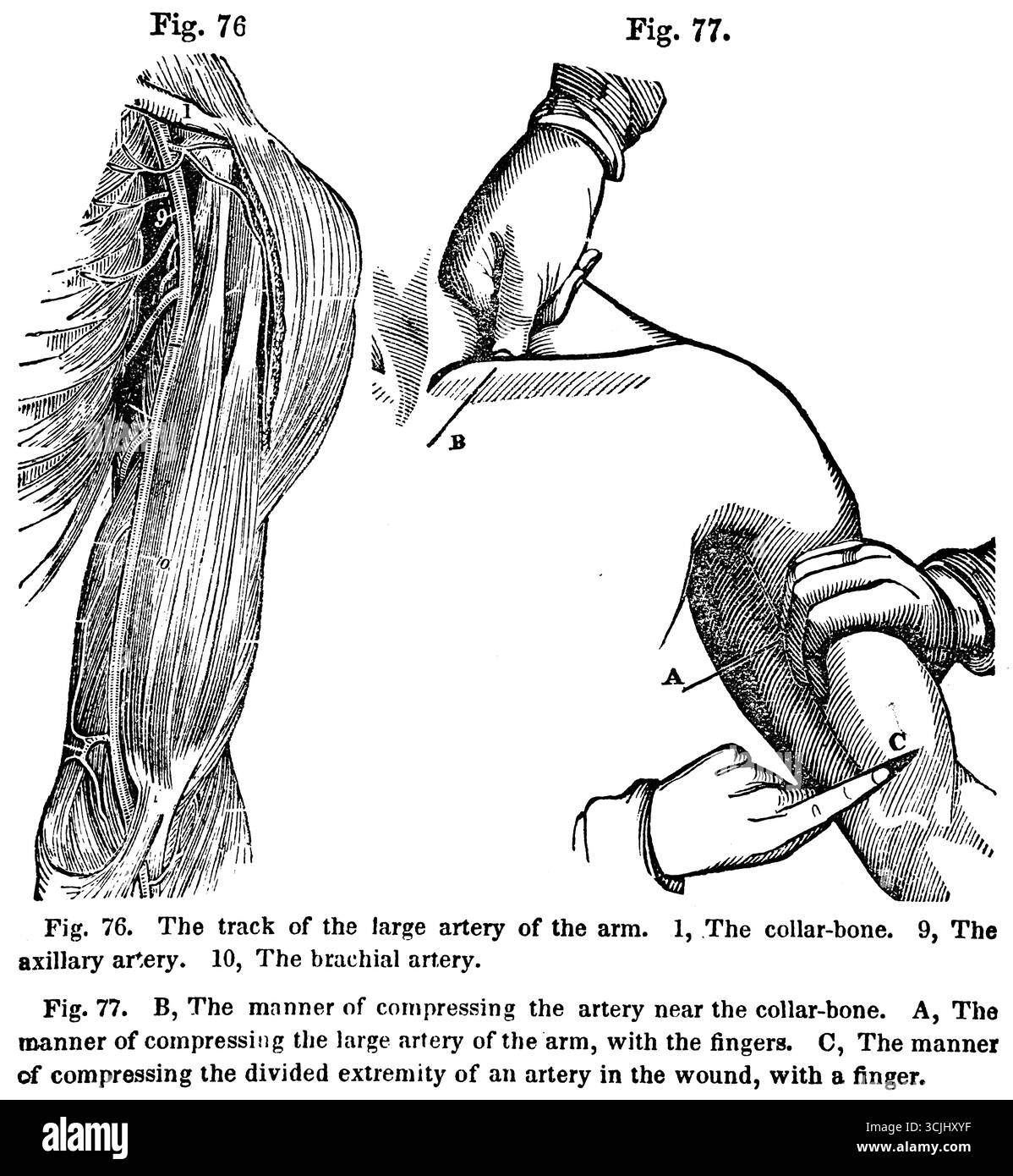 Anatomia, organi circolatori, traccia della grande arteria del braccio e modalità di compressione dell'arteria, illustrazione storica 1858 Foto Stock