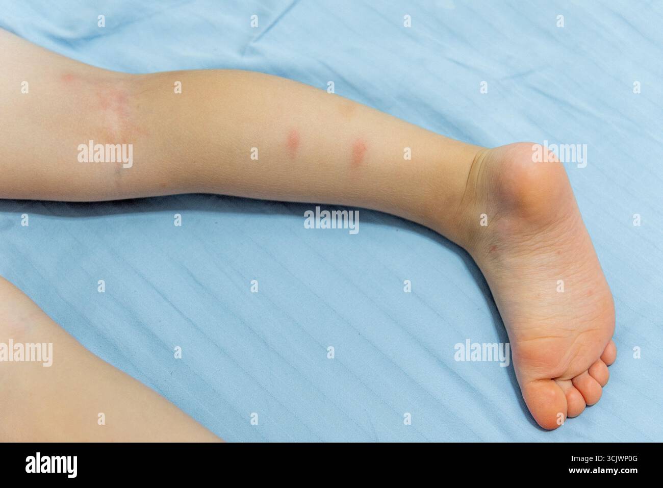 Piedi per bambini con punture di zanzara rossa pettinate primo piano, parassiti insetti succhianti sangue bit Kid Foto Stock
