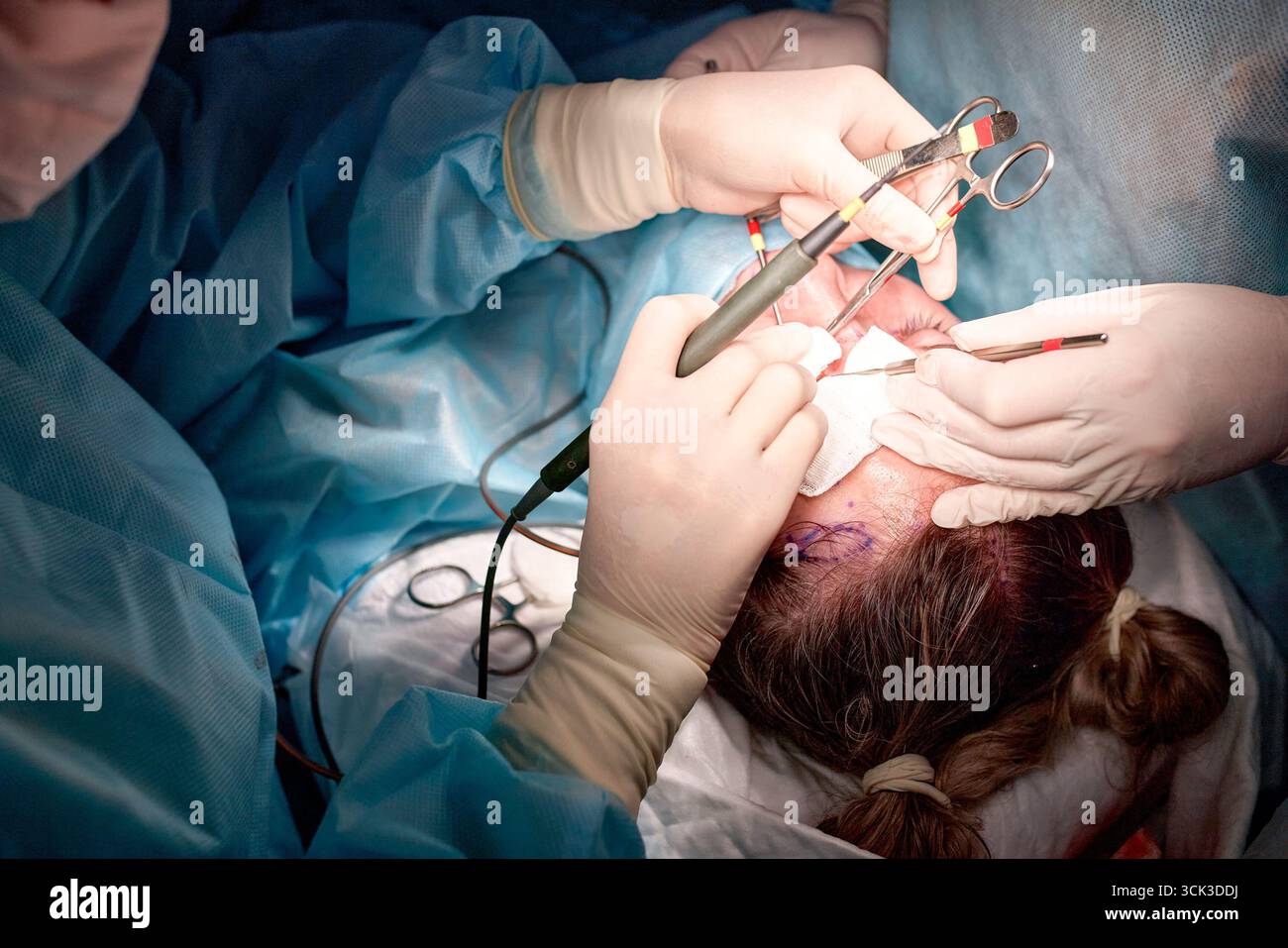 Il personale medico esegue una procedura chirurgica in un ambiente sterile utilizzando strumenti di precisione. L'attenzione è concentrata sul funzionamento attento del condu Foto Stock