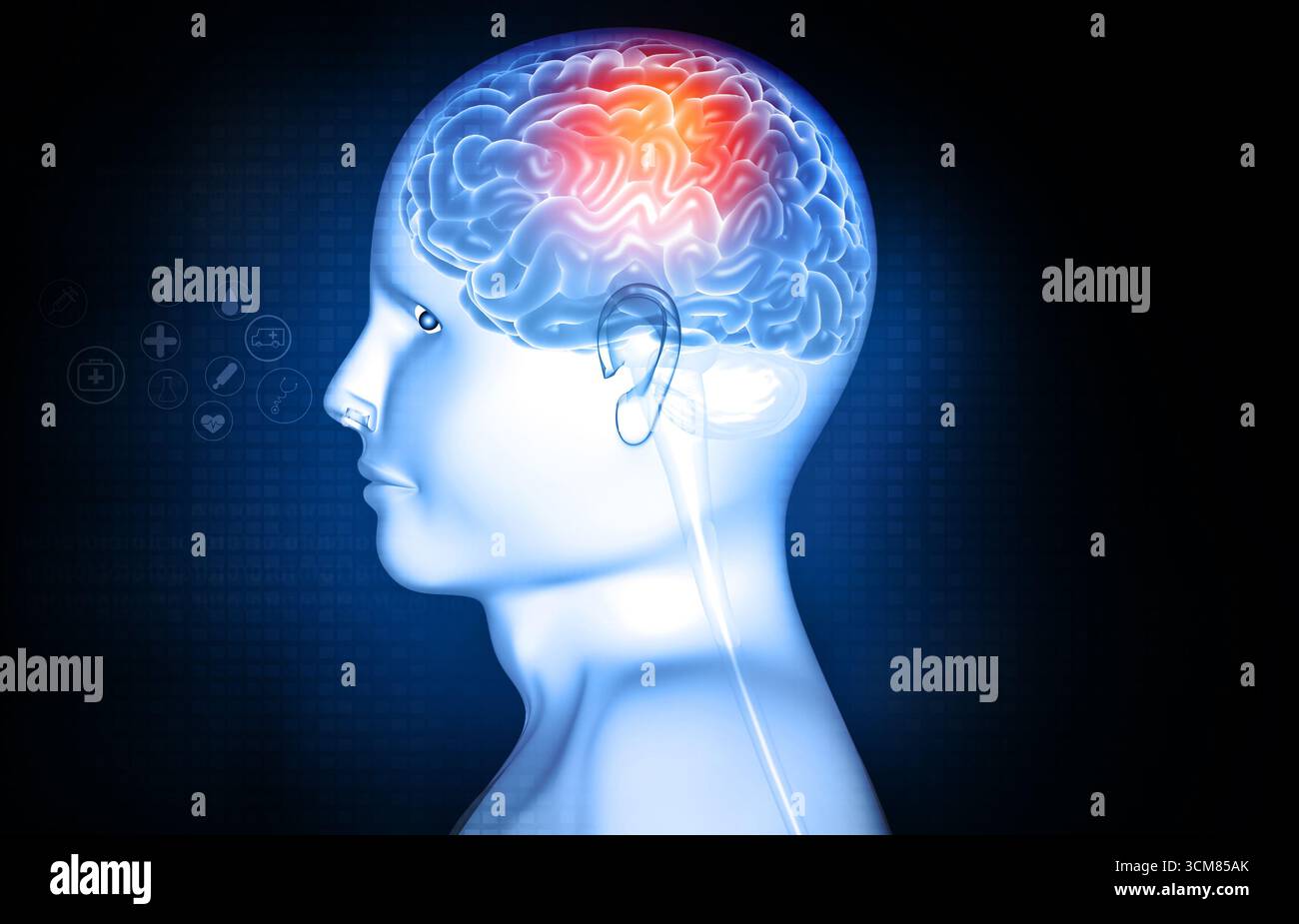 Lesione cerebrale umana, danno, emorragia.illustrazione 3d. Foto Stock