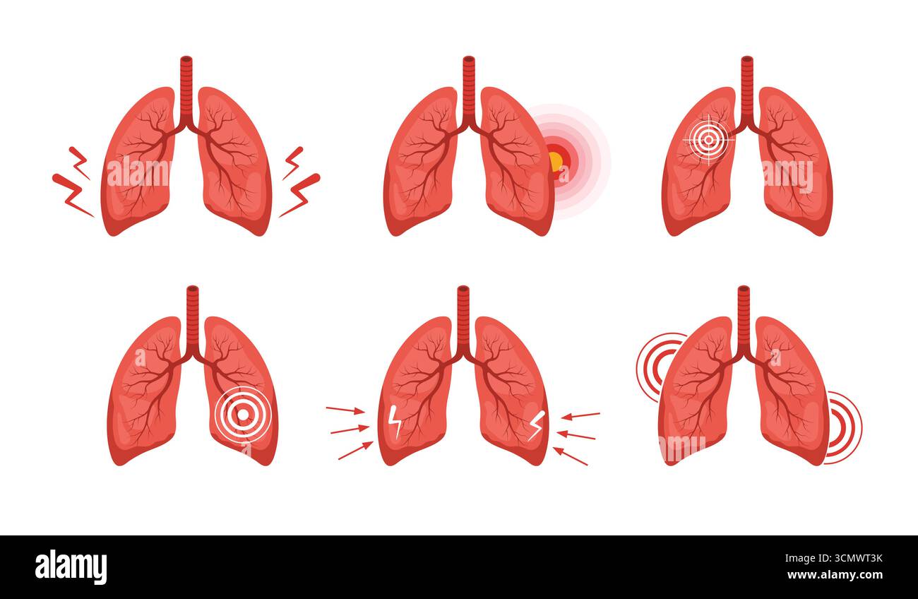 Dolore ai polmoni. Malattia degli organi interni umani. Diagnosi e trattamento medico dei polmoni. Serie di illustrazioni vettoriali in stile cartone animato piatto Illustrazione Vettoriale