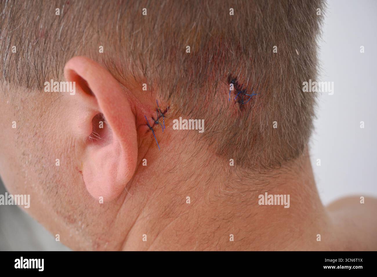 Persona che guarisce da un intervento chirurgico di rimozione di lesioni cutanee con punti visibili. Foto Stock