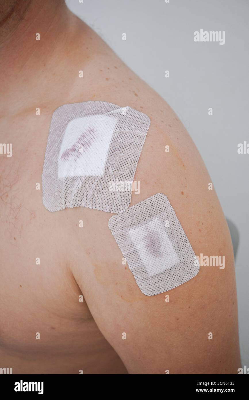 Spalla dell'uomo che mostra due cerotti chirurgici con lievi macchie di sangue che indicano guarigione. Foto Stock