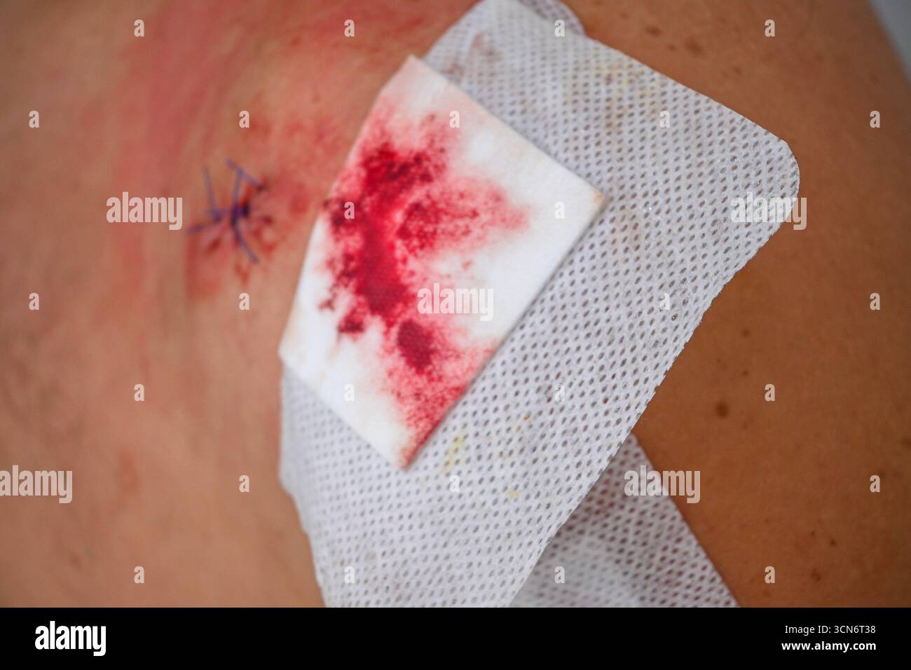 Ferita curativa con punti chirurgici e sangue su una benda bianca. Foto Stock
