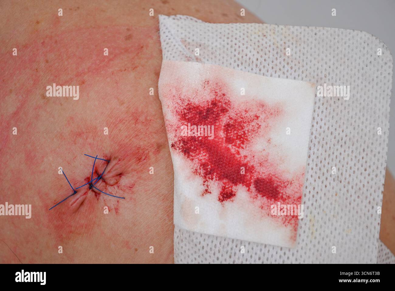 Ferita cutanea che mostra punti e sangue su una garza dopo un intervento chirurgico. Foto Stock