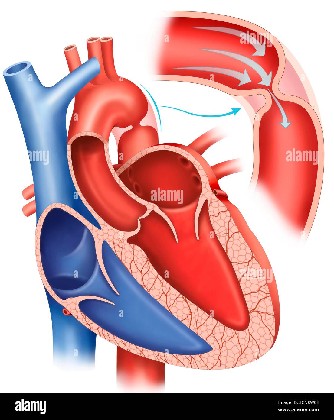 Illustrazione che si concentra su un'anomalia cardiaca, coartazione dell'aorta, in cui l'aorta si restringe più del normale, impedendo il flusso sanguigno dal cuore al resto del corpo. Questa condizione, di solito presente dalla nascita, può causare l'ipertensione e influenzare vari organi. Foto Stock