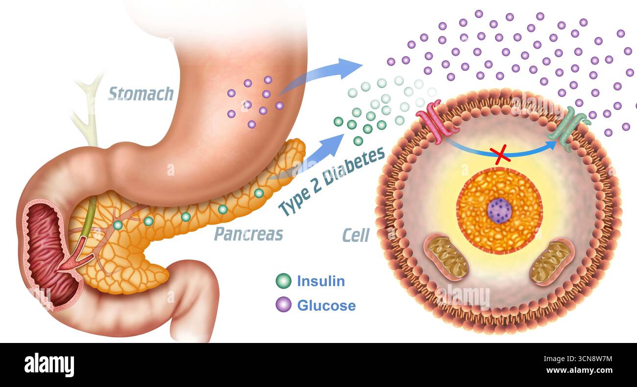 Illustrazione del diabete di tipo 2. Mostra lo stomaco, il pancreas e una cellula. Le particelle di glucosio sono viola e l'insulina è verde. Il pancreas non produce abbastanza insulina per svolgere la sua funzione di controllare lo zucchero nel sangue. Ciò provoca un aumento del glucosio che non raggiunge la cellula e ne aumenta la produzione al di fuori, portando al diabete. Foto Stock