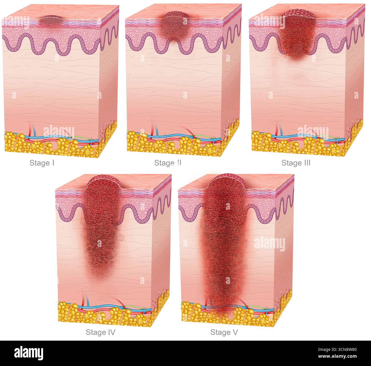 Illustrazione delle diverse fasi dello sviluppo del melanoma. Ci sono cinque stadi di melanoma, da 0 a IV, con numeri più alti che indicano una maggiore diffusione della malattia. Inoltre, alcuni stadi sono suddivisi in categorie A, B, C e D, dove le lettere indicano anche la progressione della malattia. Foto Stock