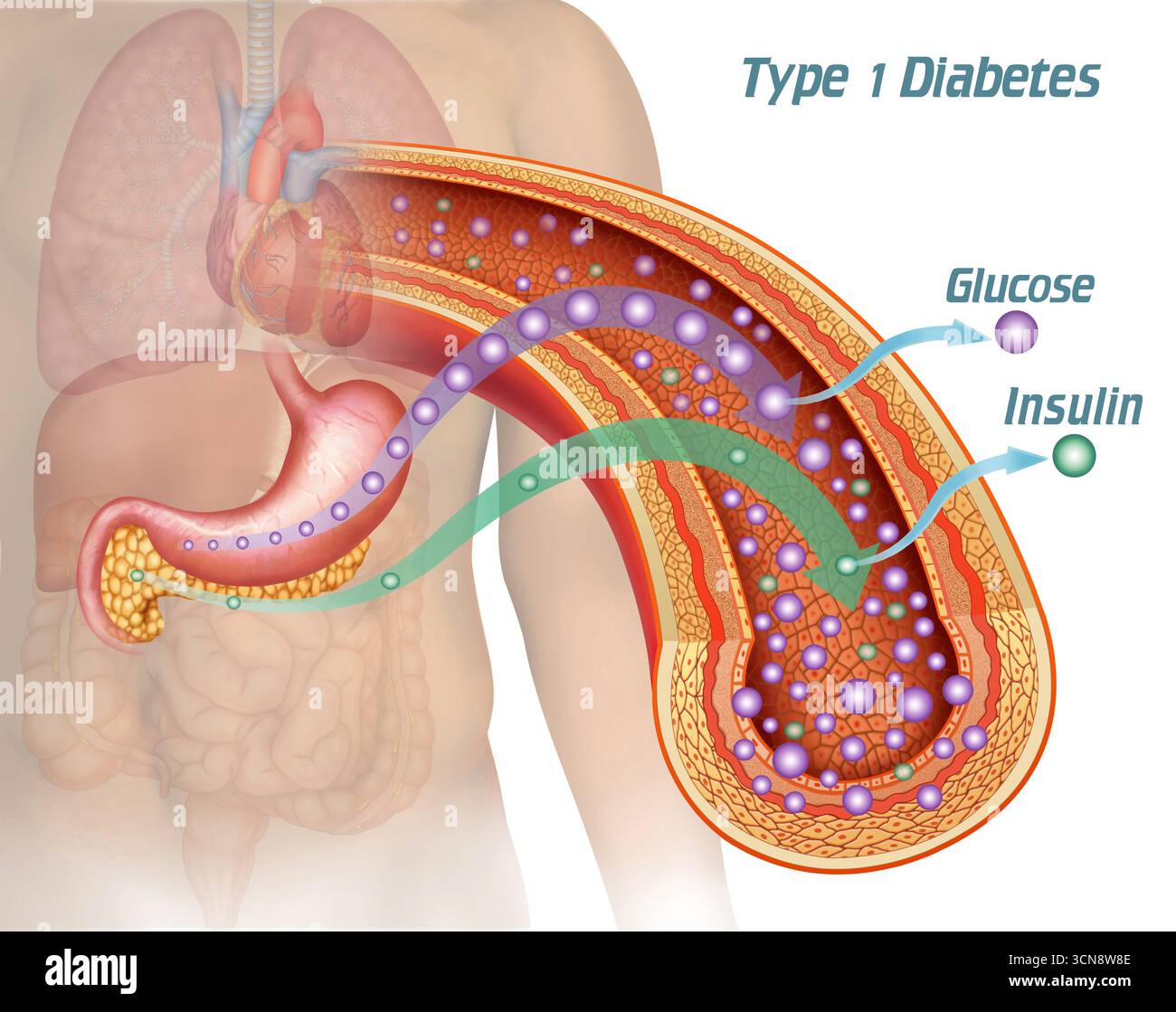 Illustrazione dello stomaco e del pancreas che mostrano un'arteria e il flusso sanguigno, che mostrano una carenza di insulina e un aumento del glucosio. Nel diabete di tipo 1, il sistema immunitario distrugge le cellule beta del pancreas, bloccando la produzione di insulina. Senza questo ormone, il glucosio non può entrare nelle cellule e accumularsi nel sangue. Foto Stock