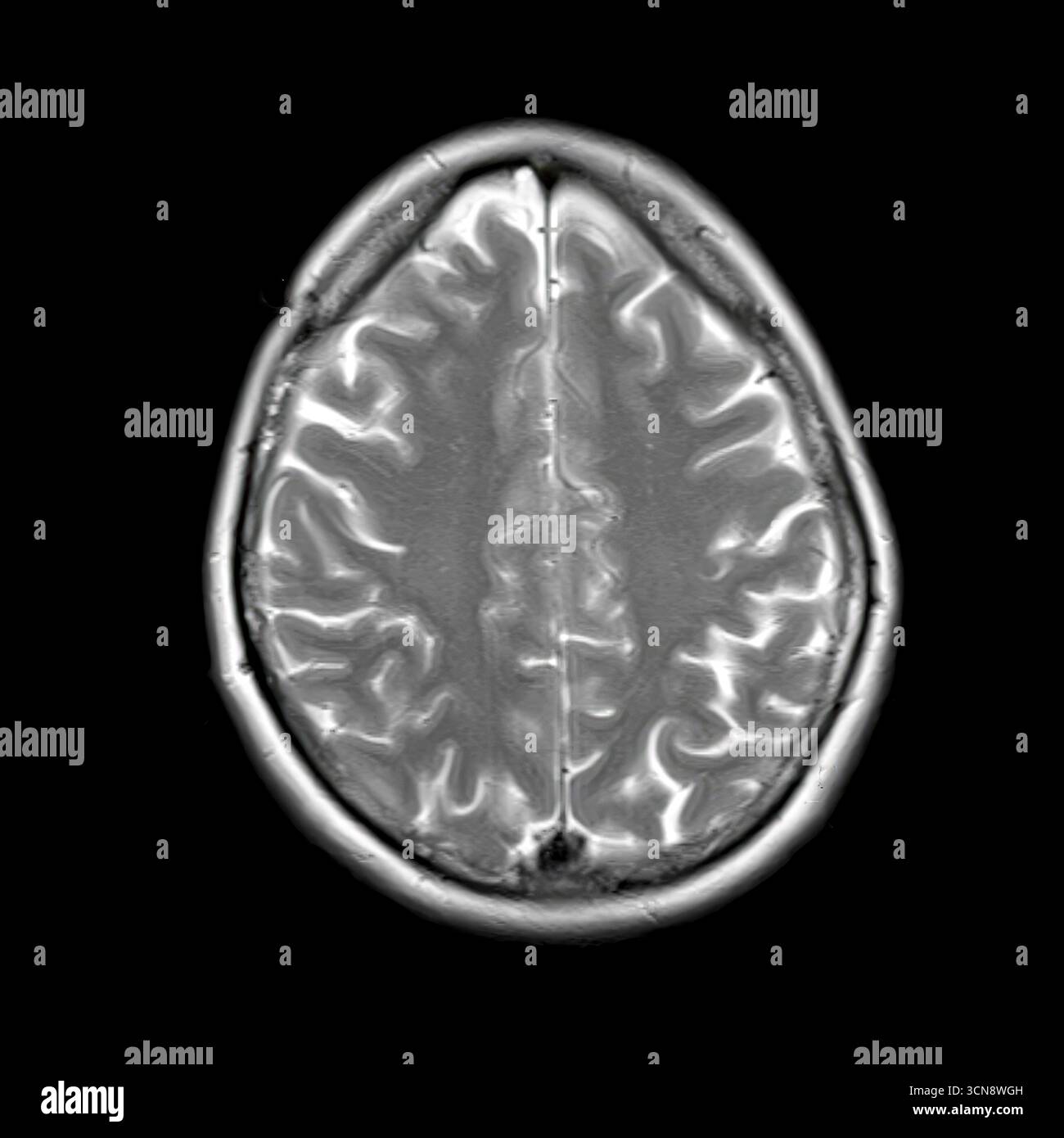 Scansione assiale con risonanza magnetica ponderata in T2 (RM) di un paziente di 40 anni che mostra una normale anatomia corticale cerebrale con giroscopio, solchi, materia bianca ben definiti e assenza di anomalie o lesioni visibili. Foto Stock
