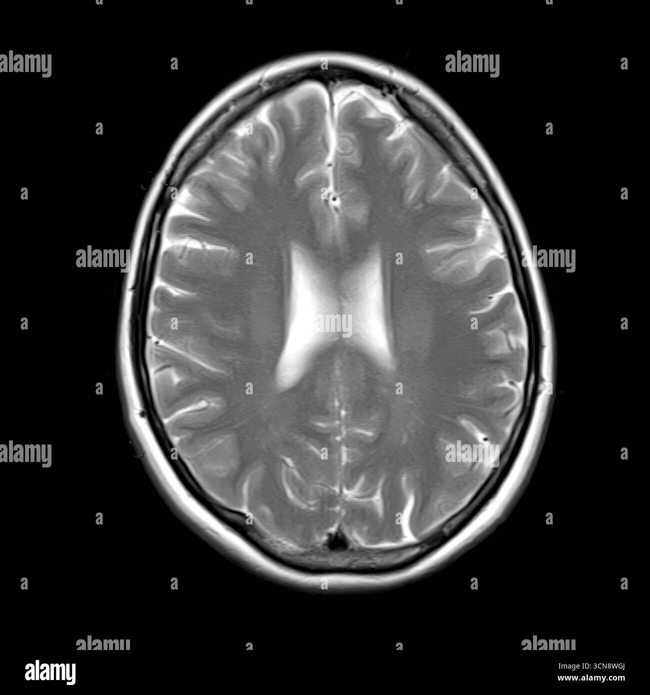 Scansione di risonanza magnetica (RM) che mostra ventricoli laterali normali, corpus calloso e materia bianca circostante senza anomalie visibili. Foto Stock