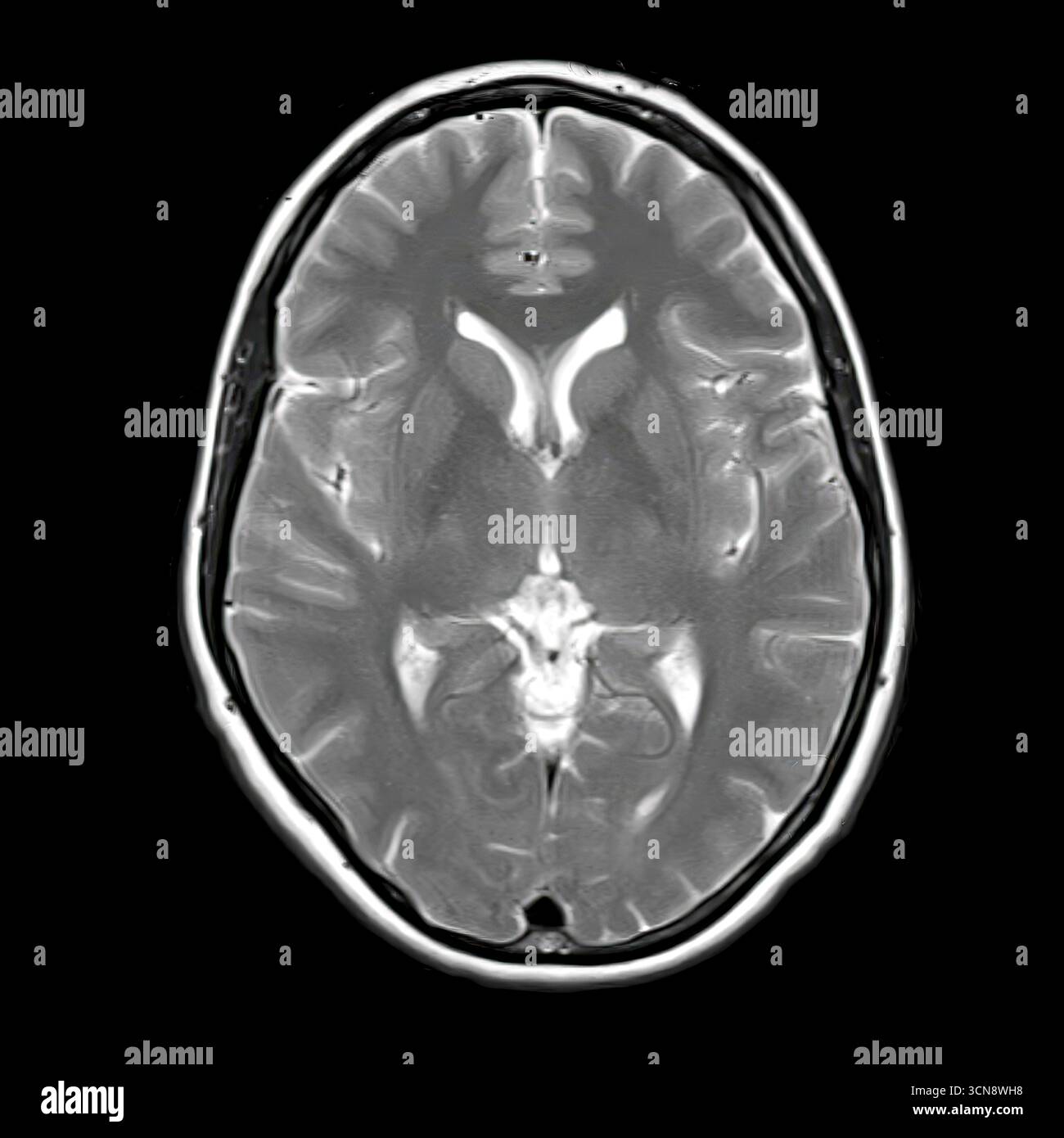 Scansione a risonanza magnetica (RM) del cervello umano che mostra l'anatomia normale di ventricoli laterali, talamo e gangli basali senza patologia visibile. Foto Stock