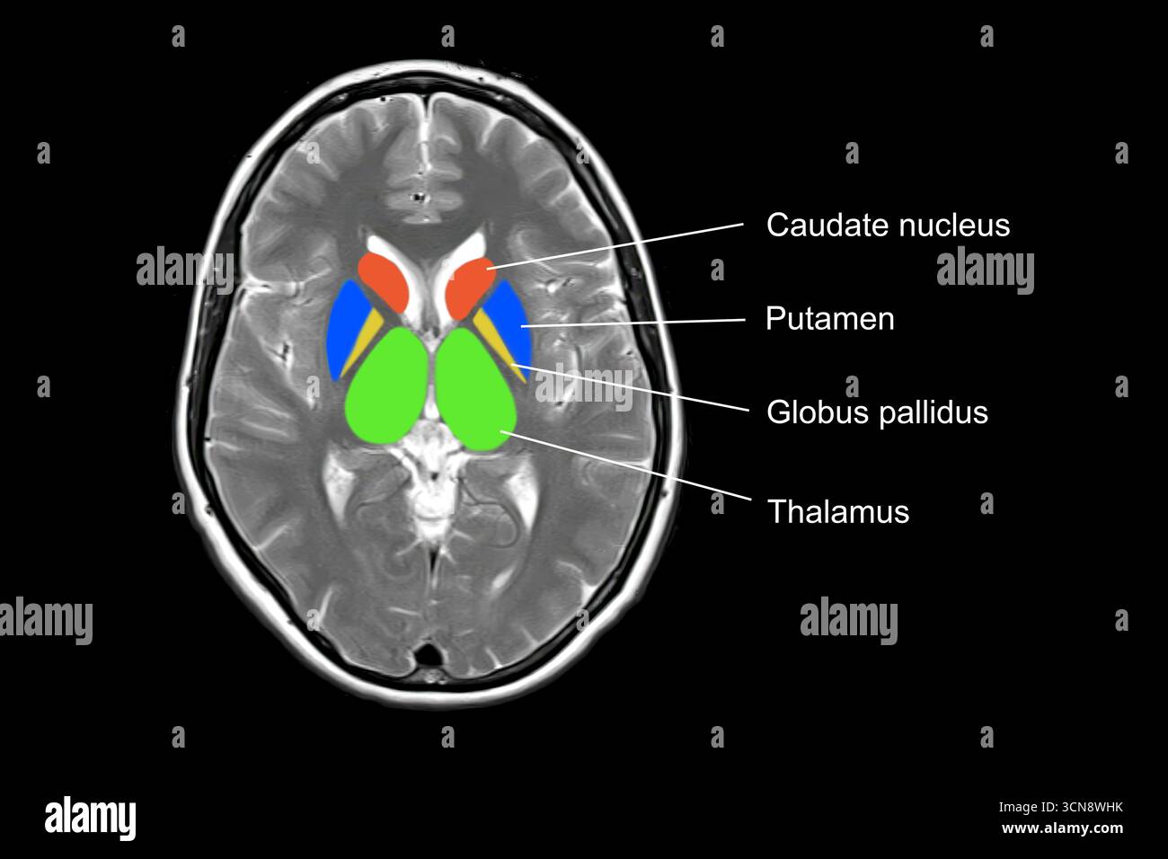 Scansione di risonanza magnetica (RM) che mostra una normale anatomia cerebrale con gangli basali e talami marcati. Foto Stock