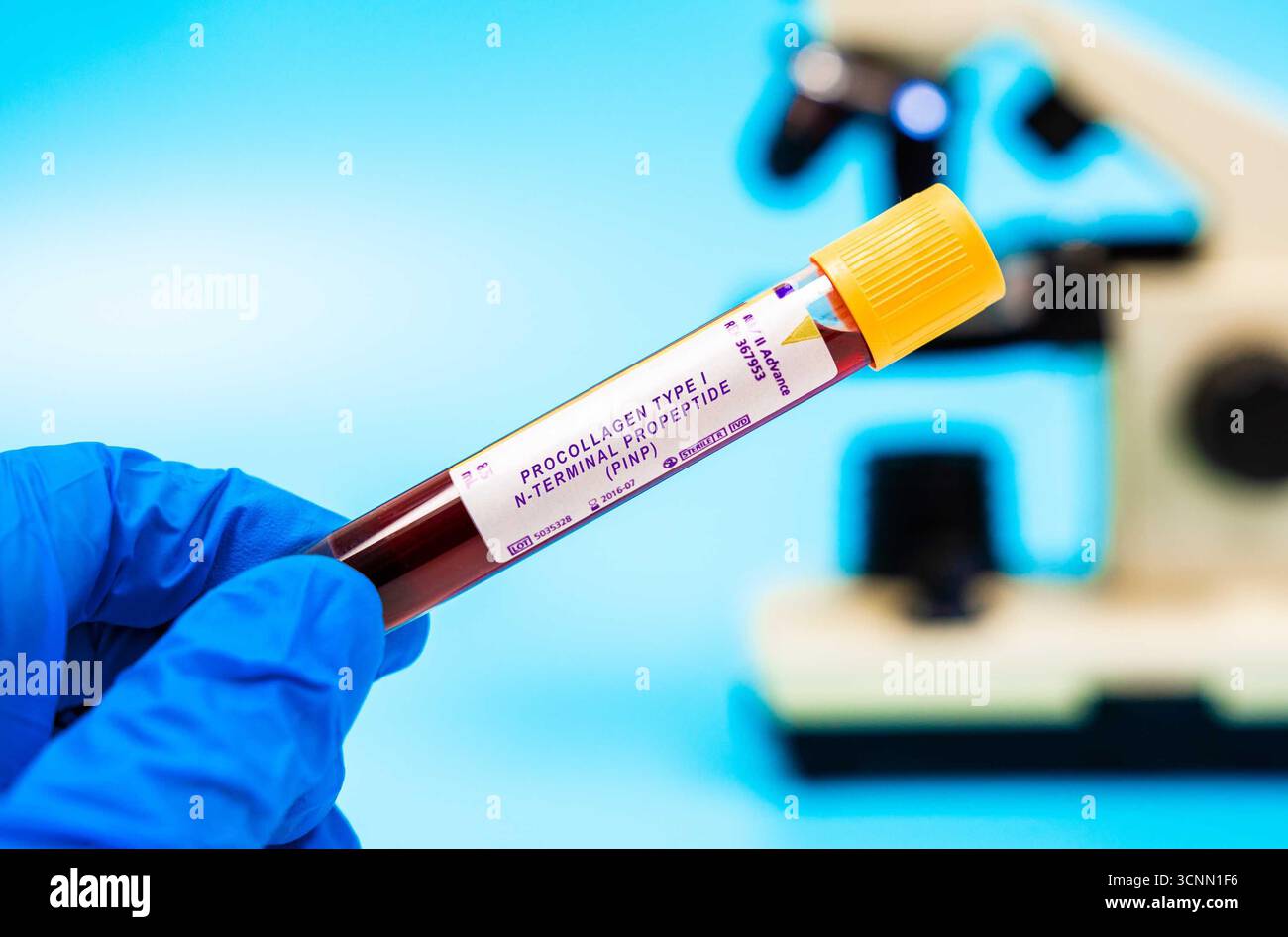 Il marcatore del turnover osseo valuta i livelli di PINP, utilizzato per monitorare il metabolismo osseo nei pazienti affetti da tumore con metastasi ossee. Analisi del sangue in laboratorio Foto Stock