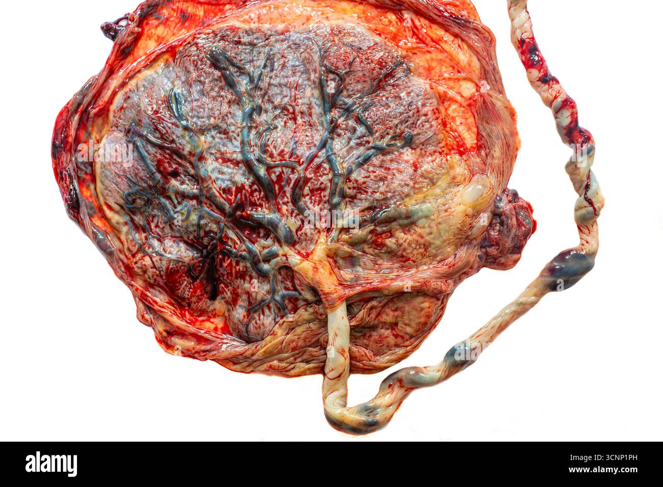 Placenta umana con cordone ombelicale subito dopo la nascita, isolata su bianco Foto Stock