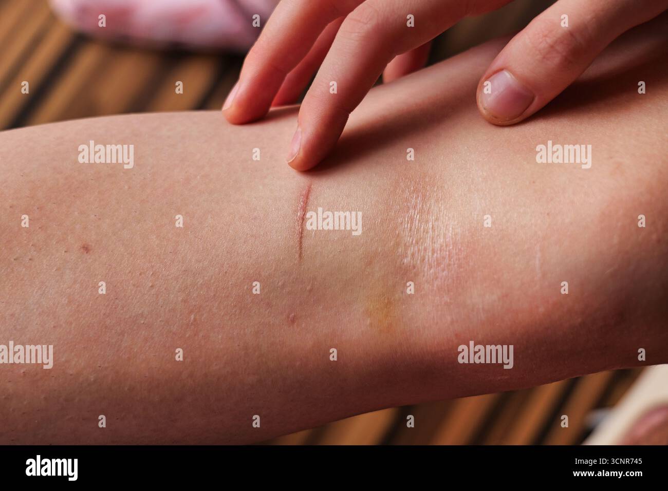Puntando alla cicatrice lineare bianca sottile sulla pelle del braccio umano con lividi sottili alla luce del giorno Foto Stock