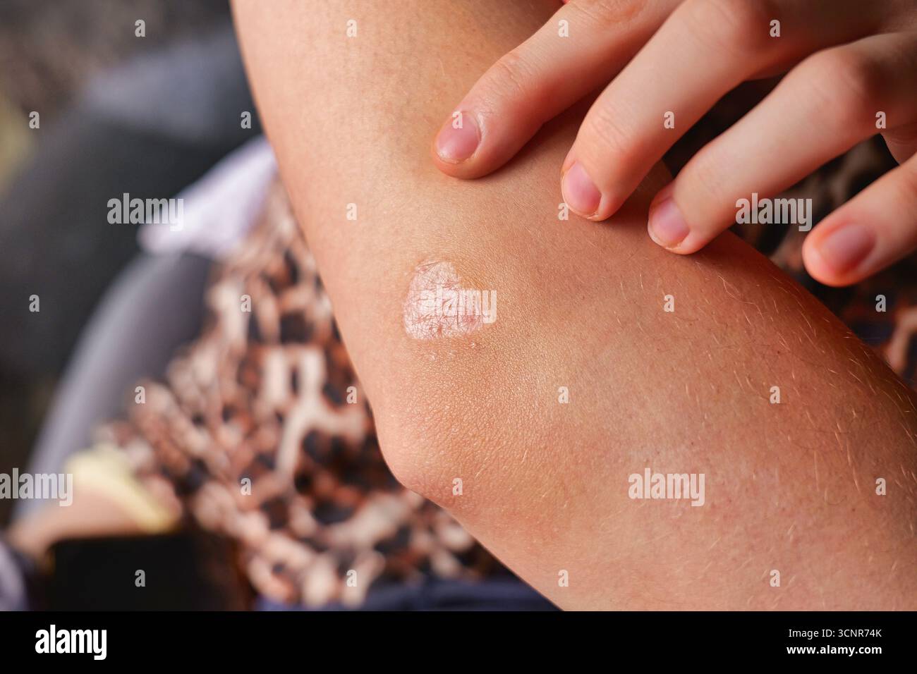 Primo piano del braccio umano con la placca bianca di cicatrice appuntita dal dito sulla superficie della pelle in luce naturale Foto Stock