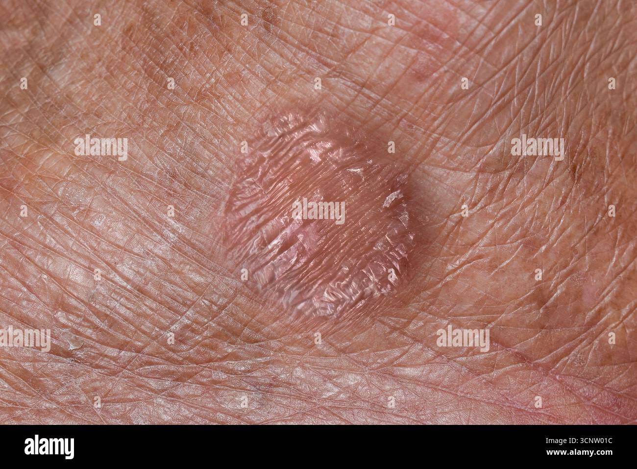 L'aspetto ruvido e squamoso di un'infezione fungina della tigna sulla pelle umana. Foto Stock