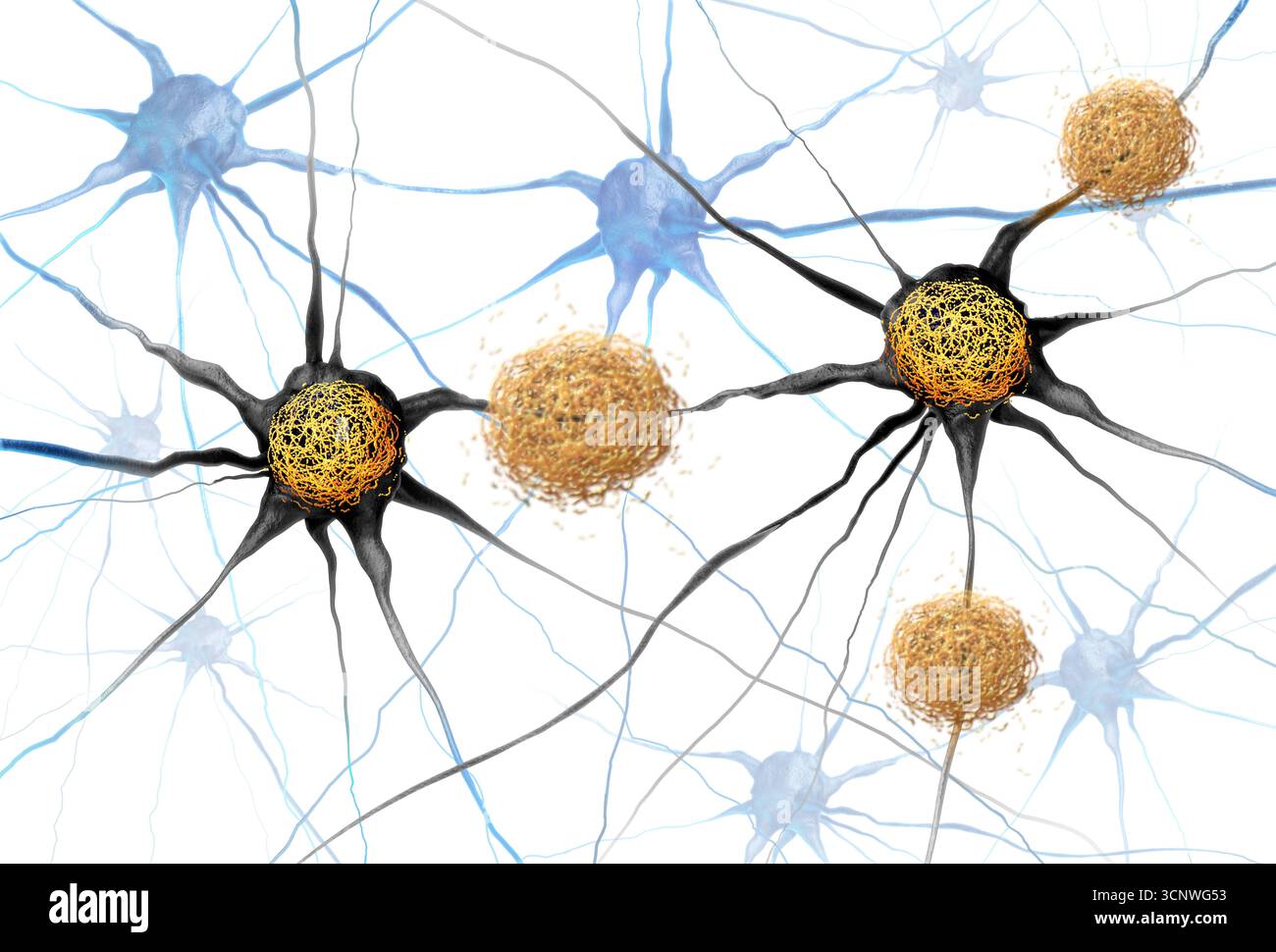 I grovigli amiloidi Beta e Tau si intendono come ammassi anomali di frammenti proteici che si accumulano tra le cellule nervose e all'interno delle cellule neuroniche nel brai Foto Stock