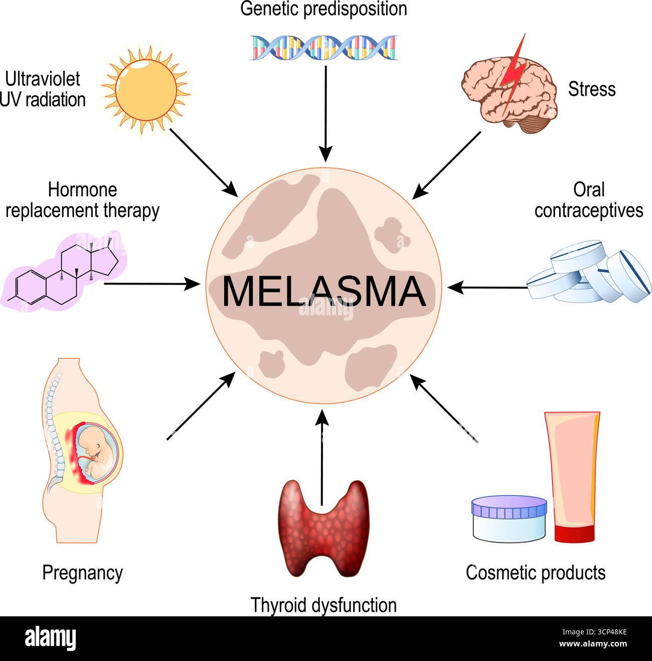 Trigger melasma. Chloasma faciei. Maschera di gravidanza. Illustrazione vettoriale. Illustrazione Vettoriale