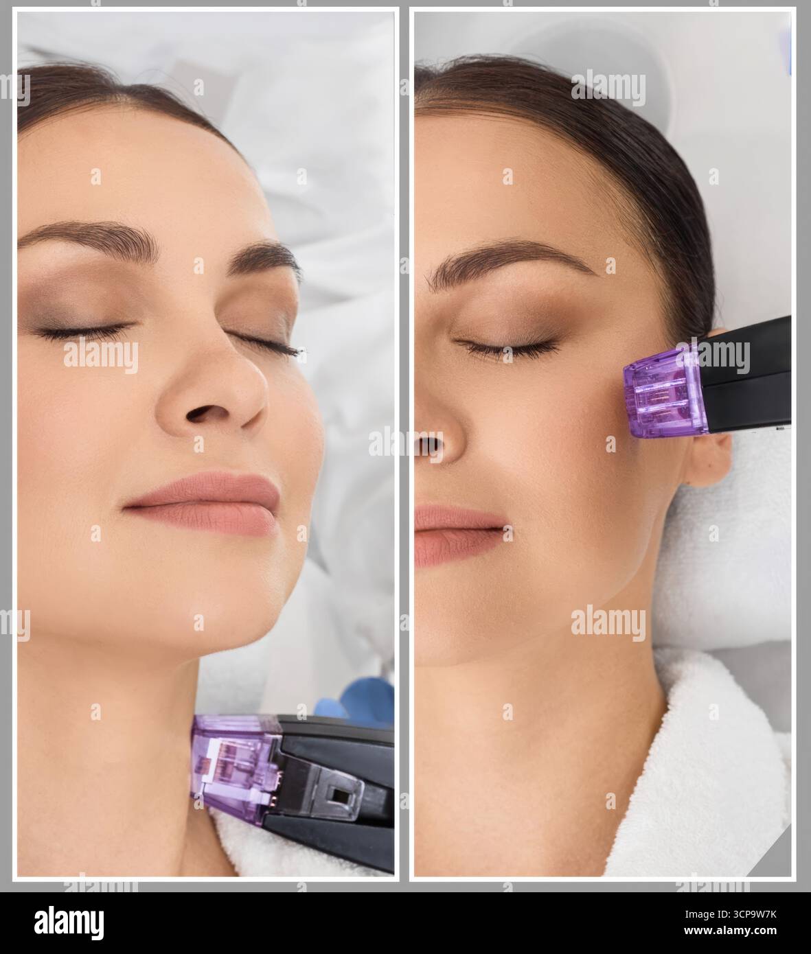 Sollievo della pelle di una bella paziente in un salone di bellezza per migliorare l'elasticità e il serraggio della pelle del collo, collage fotografico. Sollevamento RF Foto Stock