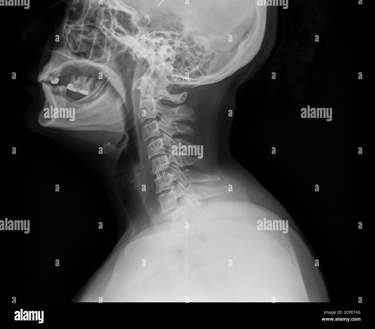 Radiografia a raggi X laterale del collo umano e della colonna cervicale su sfondo nero. Immagine diagnostica medica. Vertebre, base del cranio e vie aeree Foto Stock