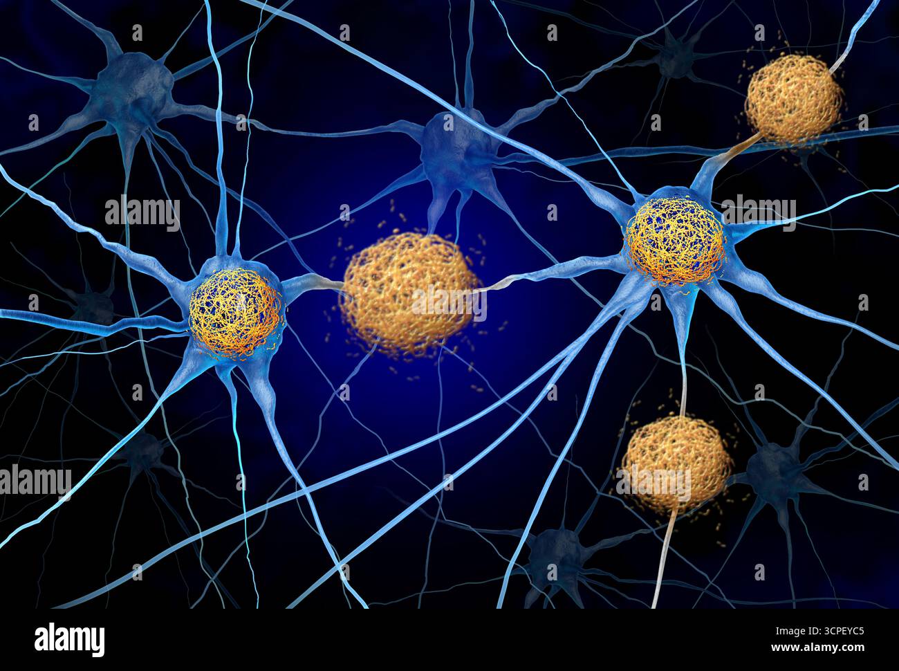 Tau Tangles e Amyloid Beta concetto come ammassi anomali di frammenti proteici che si accumulano tra le cellule nervose e all'interno delle cellule neuroniche nel brai Foto Stock