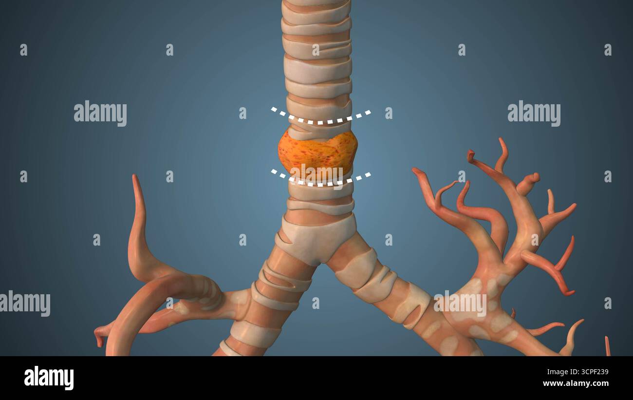 Infected tracheal Segment Removal Surgery Animation Foto Stock