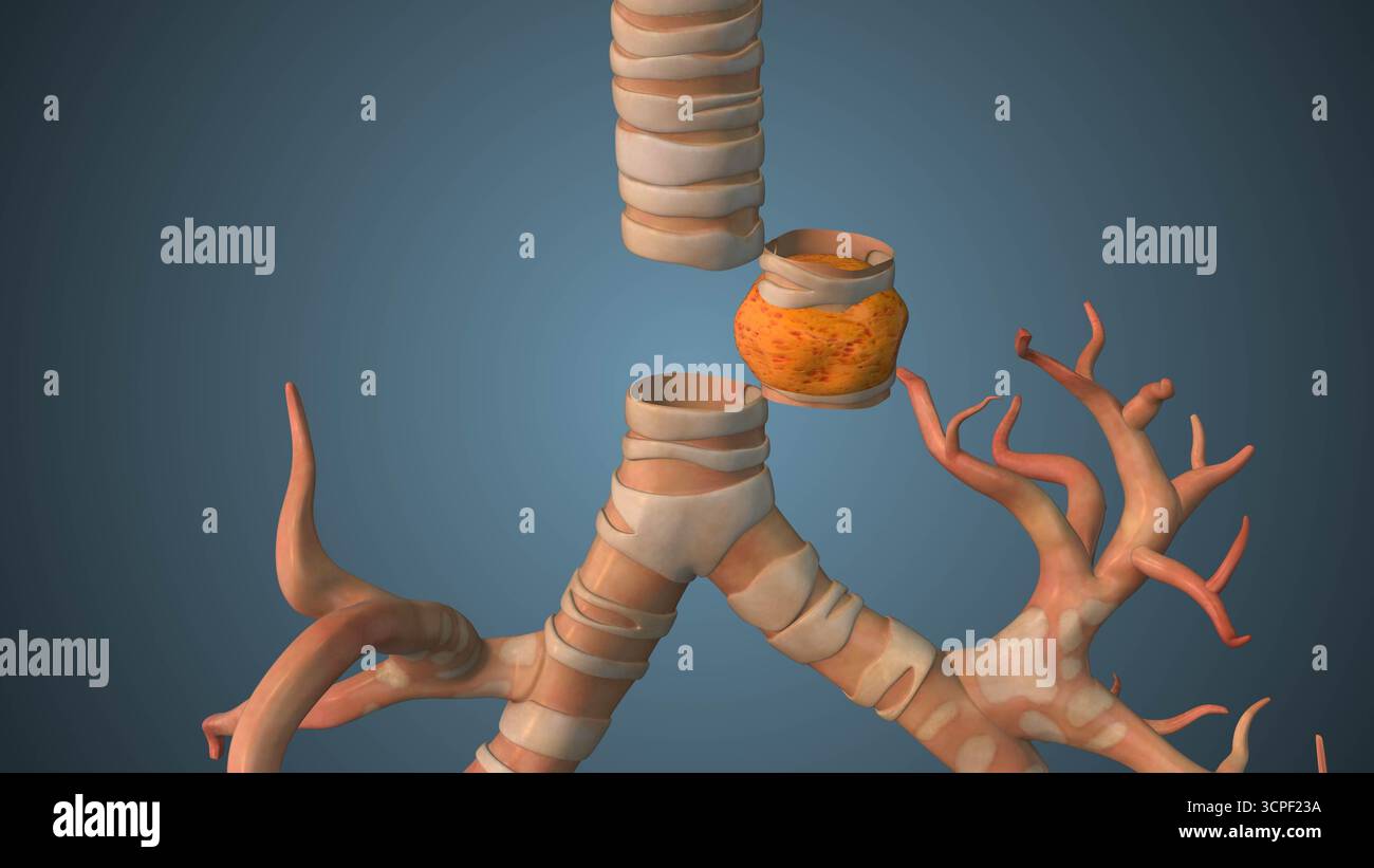 Infected tracheal Segment Removal Surgery Animation Foto Stock