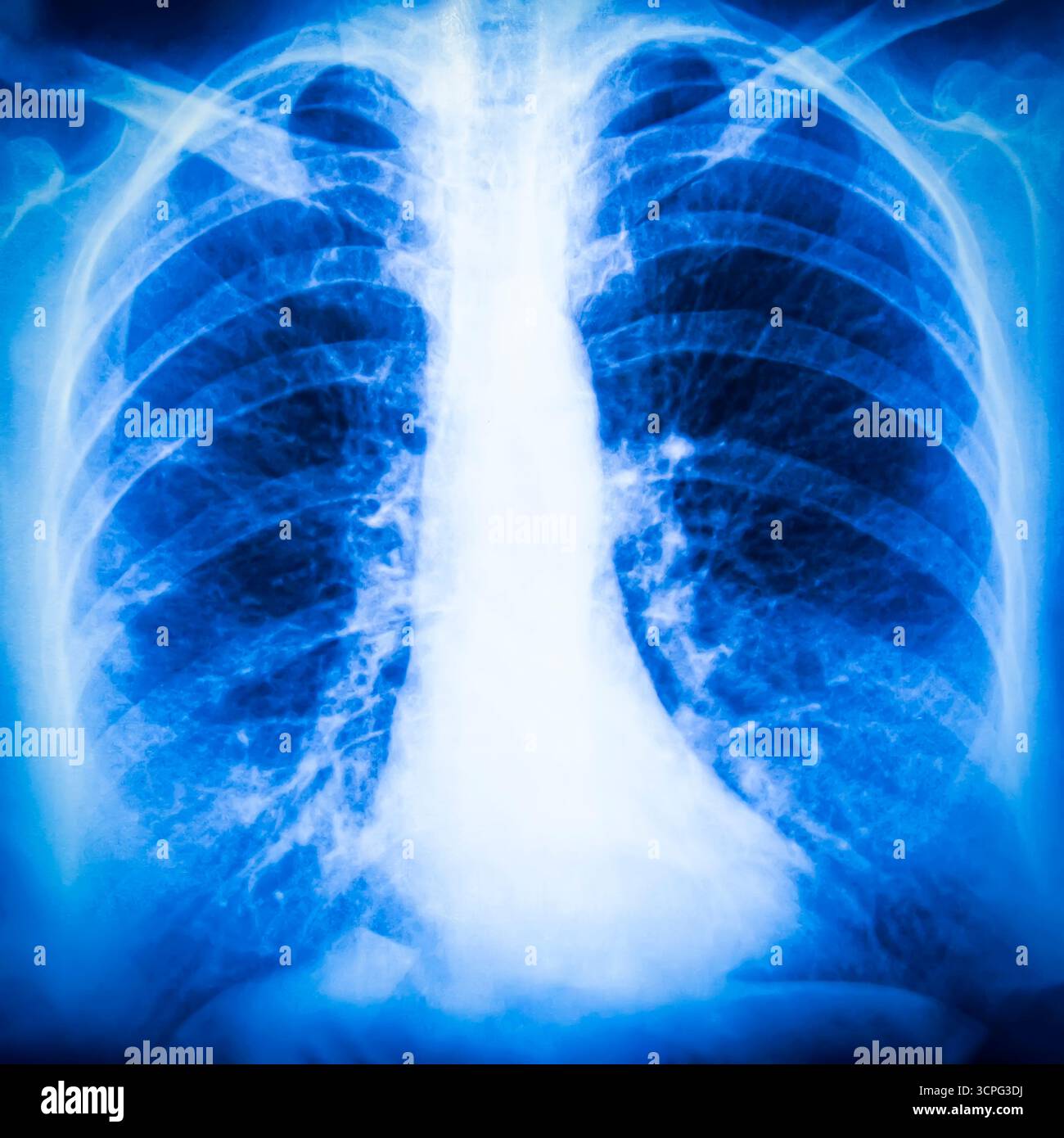 Radiografia del torace che visualizza l'anatomia polmonare dettagliata e il contorno cardiaco. La scansione evidenzia le caratteristiche strutturali del sistema respiratorio e dell'ambiente circostante Foto Stock