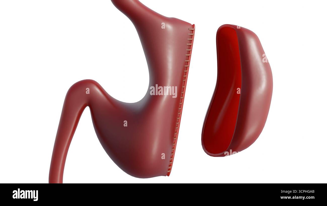 Rendering medico 3D che illustra la procedura nota come guaina di gastrectomia o guaina gastrica. Foto Stock Rendering medico 3D che illustra la procedura nota come guaina di gastrectomia o guaina gastrica. Foto Stock