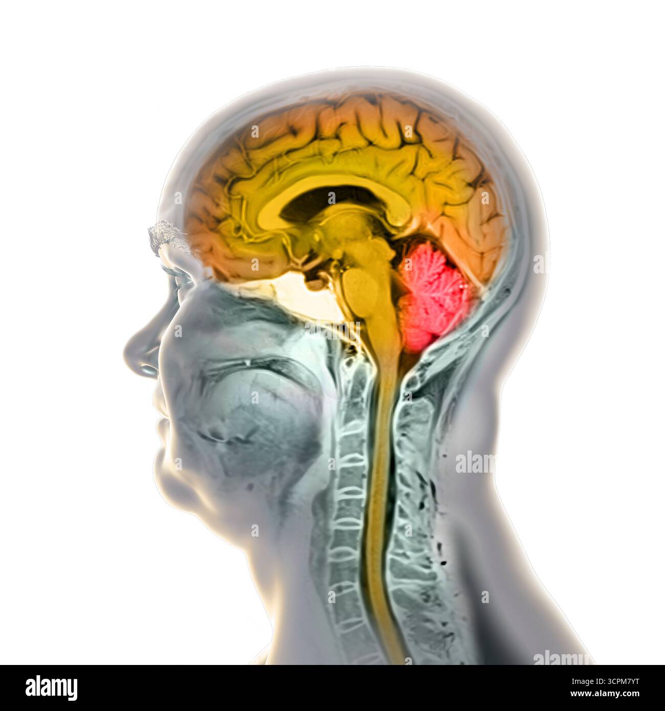 Immagine di una scansione a risonanza magnetica colorata (MRI) del cervello e del collo, che mostra l'anatomia del sistema nervoso centrale e la colonna cervicale. Foto Stock