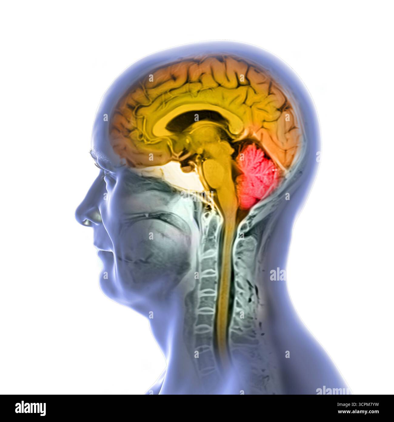 Immagine di una scansione a risonanza magnetica colorata (MRI) del cervello e del collo, che mostra l'anatomia del sistema nervoso centrale e la colonna cervicale. Foto Stock