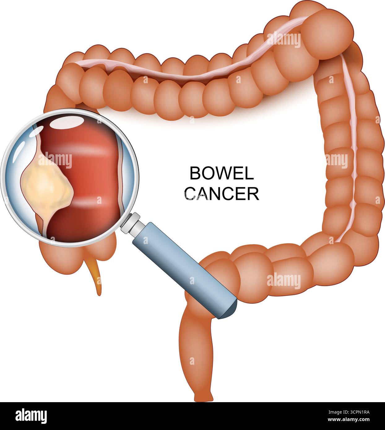 Cancro all'intestino. Cancro colorettale. Intestino crasso umano. Tumore maligno attraverso una lente di ingrandimento. Diagramma vettoriale. illustrazione. Illustrazione Vettoriale