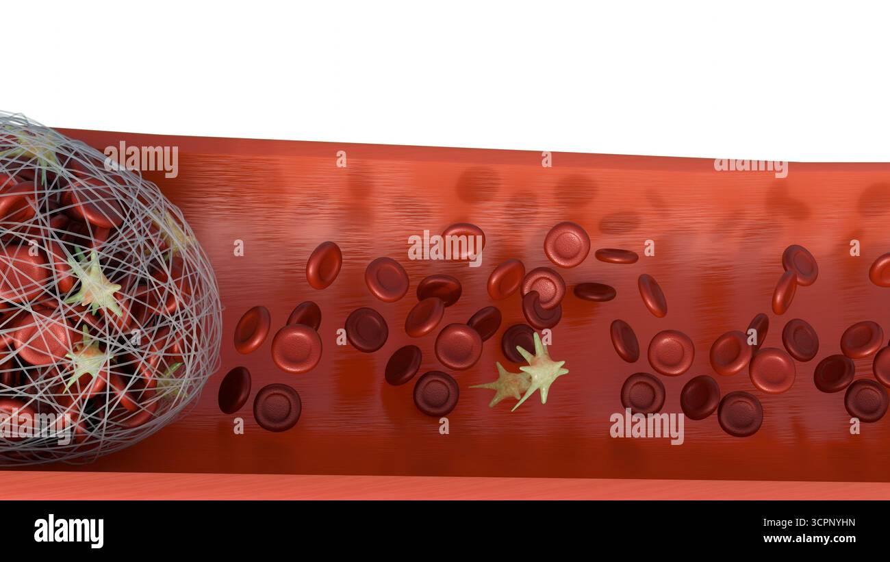 Immagine 3D della formazione di trombi all'interno di un vaso sanguigno Foto Stock