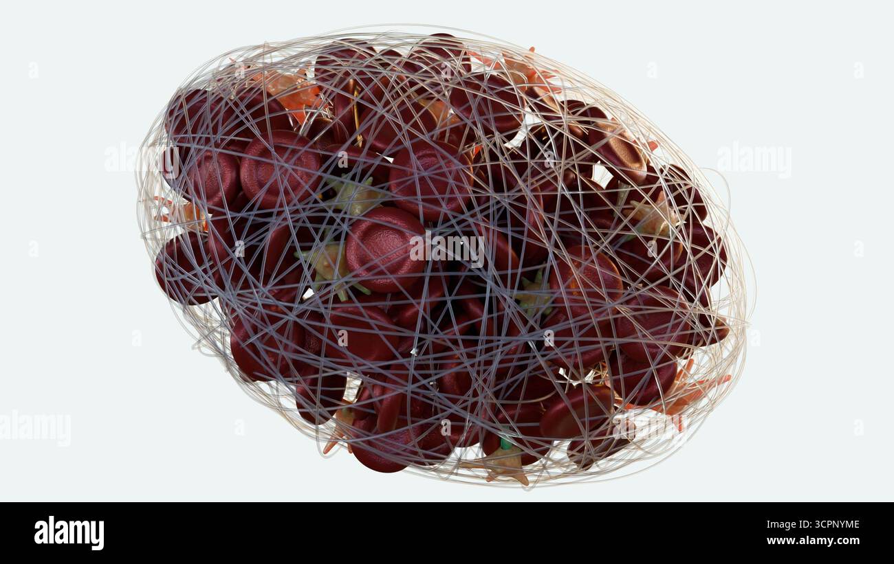 Immagine 3D della formazione di trombi all'interno di un vaso sanguigno Foto Stock