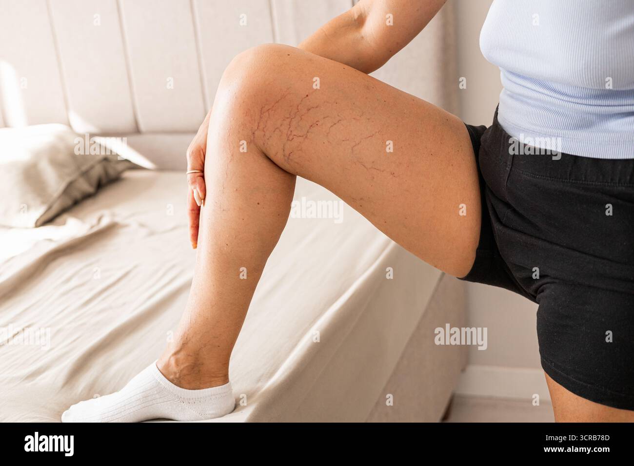 Primo piano di una gamba che mostra vene varicose e capillari visibili. La persona indossa pantaloncini neri e calzini bianchi, con un letto sullo sfondo. Foto Stock