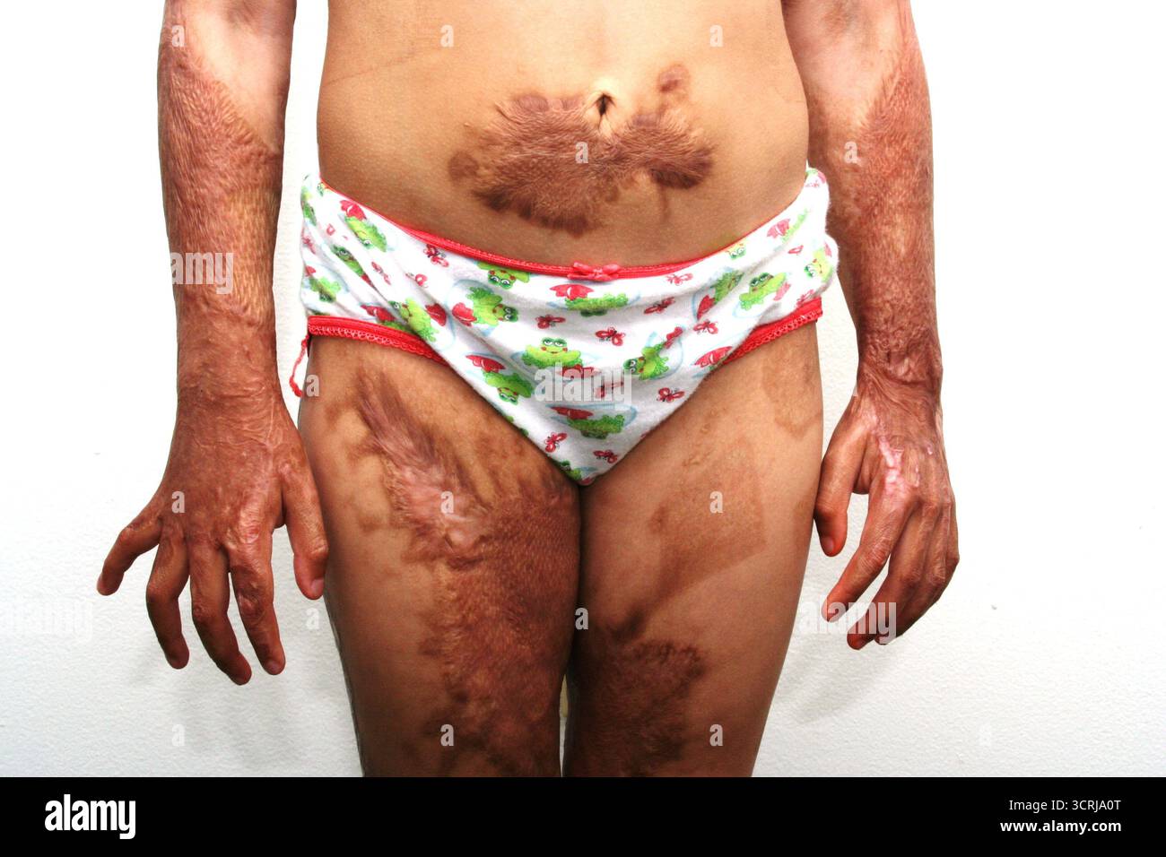 Brucia da un incendio su un bambino Foto Stock