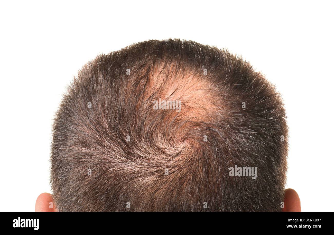 Uomo con macchie calve su sfondo bianco, vista posteriore Foto Stock