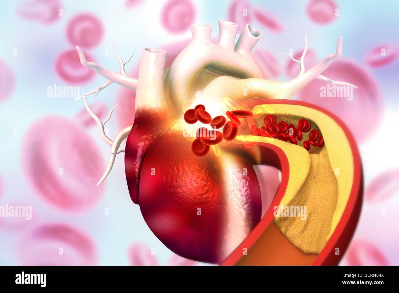 Placca di colesterolo nell'arteria con anatomia del cuore umano. illustrazione 3d. Foto Stock