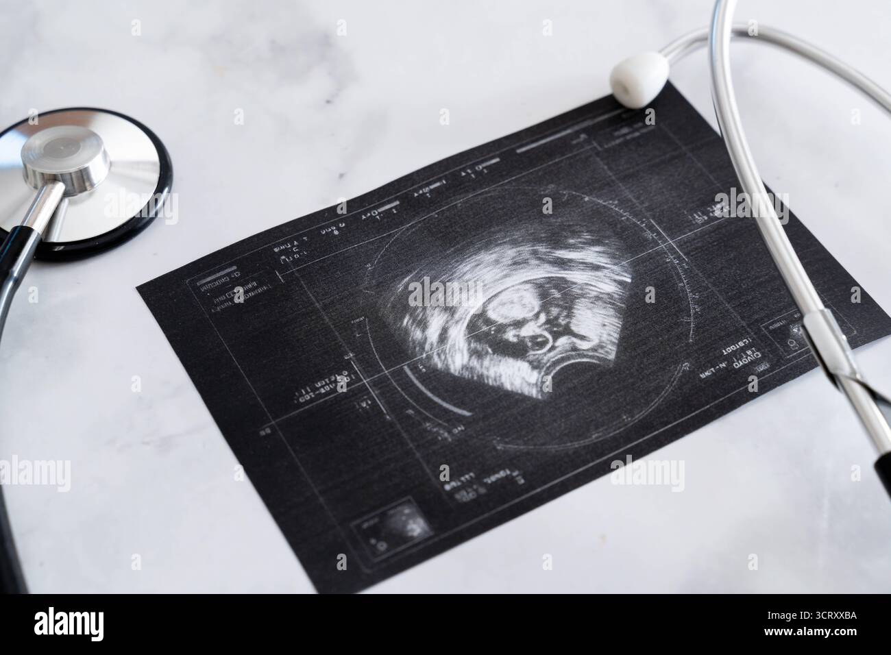 Baviera, Germania - 3 ottobre 2025: Immagine ecografica con feto, incorniciata da due stetoscopi. Foto simbolica di gravidanza, screening e medicina prenatale *** Ultraschallbild mit Fötus, eingerahmt von zwei Stethoskopen. Symbolfoto zu Schwangerschaft, Vorsorgeuntersuchung und pränataler Medizin Foto Stock