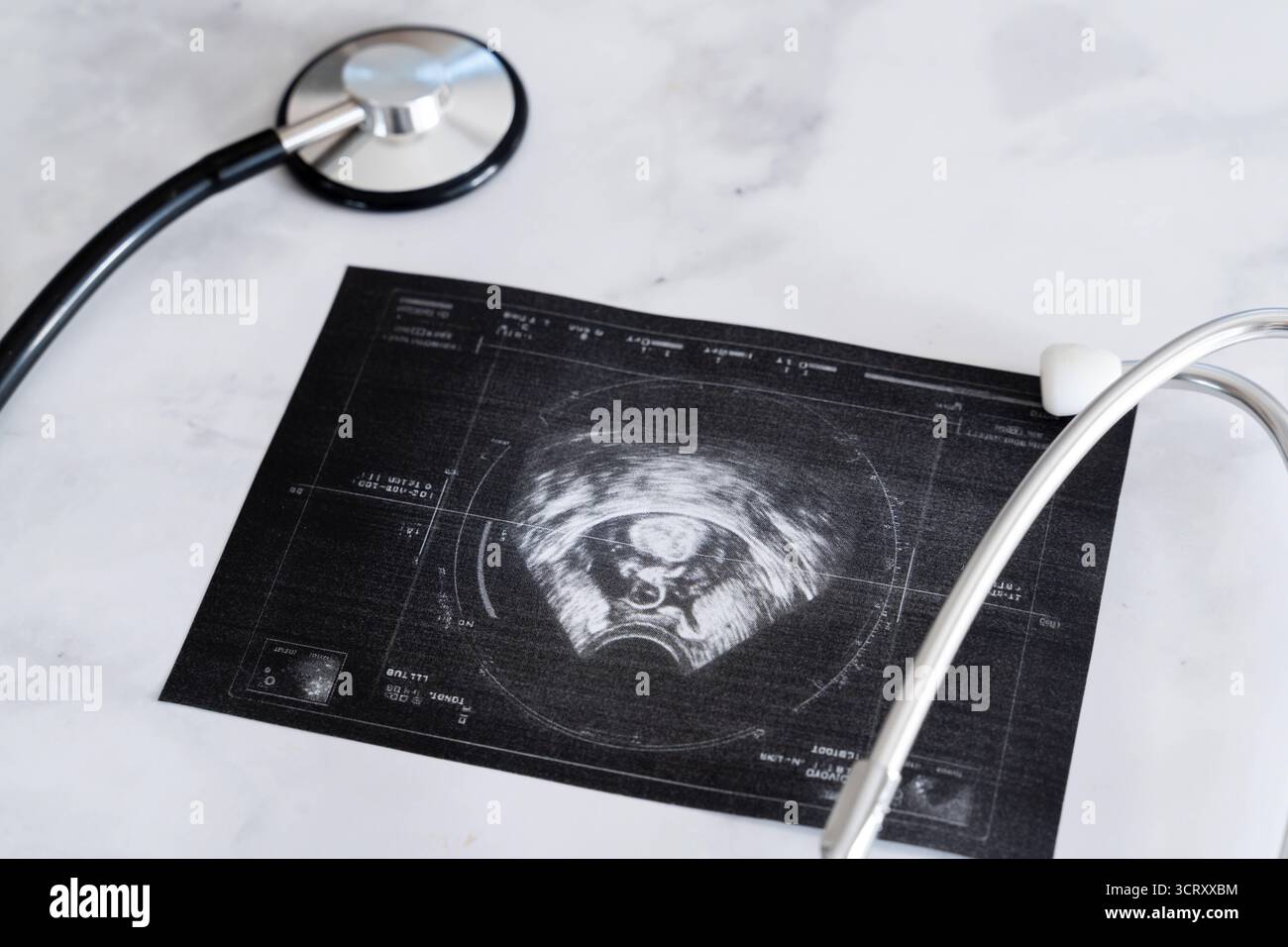 Baviera, Germania - 3 ottobre 2025: Immagine ecografica con feto, incorniciata da due stetoscopi. Foto simbolica di gravidanza, screening e medicina prenatale *** Ultraschallbild mit Fötus, eingerahmt von zwei Stethoskopen. Symbolfoto zu Schwangerschaft, Vorsorgeuntersuchung und pränataler Medizin Foto Stock