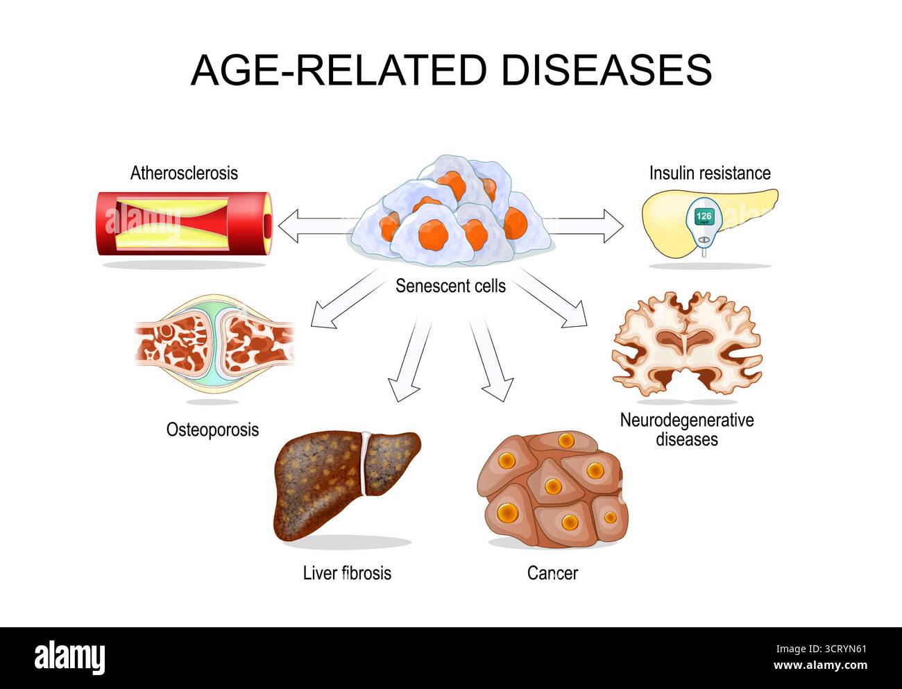 Cellule senescenti, cancro e malattie legate all'età. Illustrazione vettoriale Illustrazione Vettoriale
