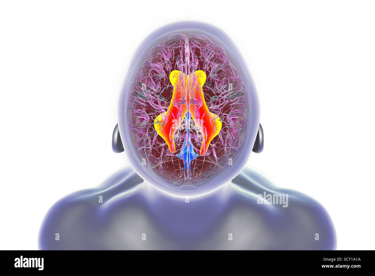 Illustrazione dei ventricoli laterali ingrossati del cervello (idrocefalo). Foto Stock