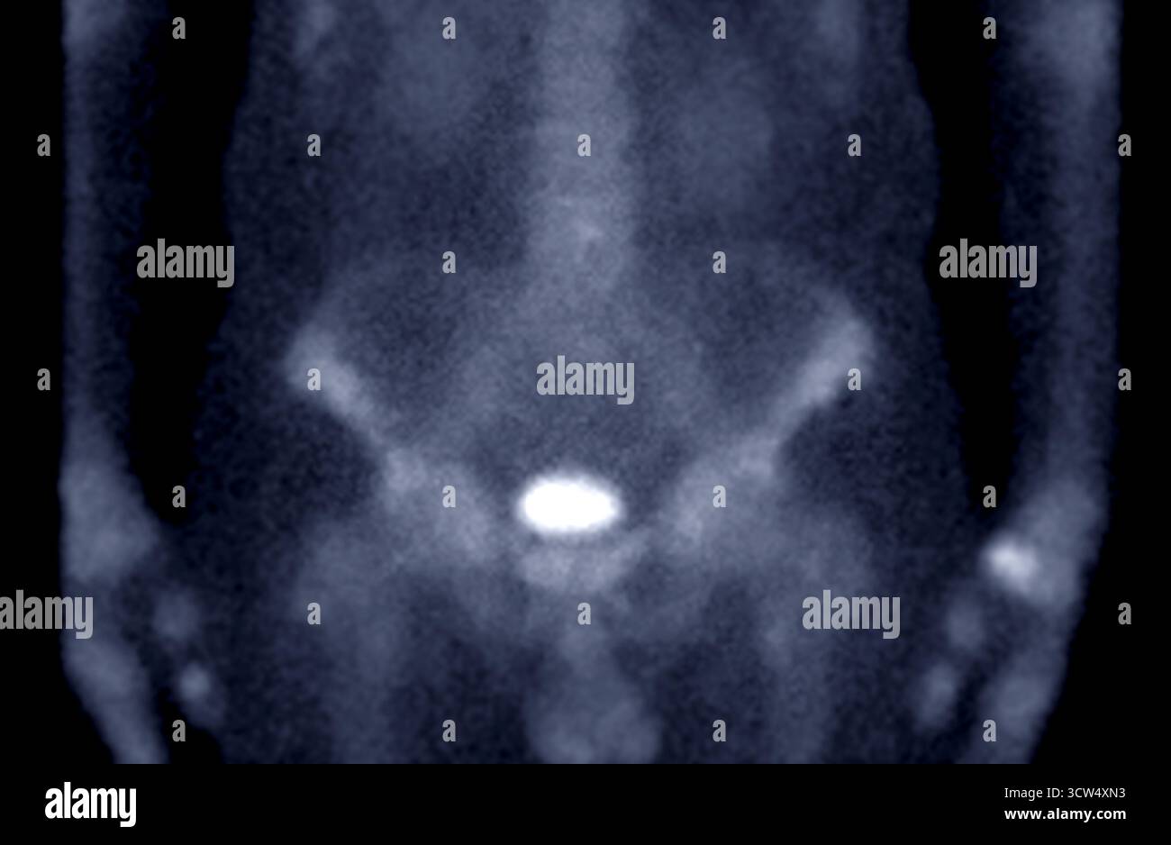 La scansione ossea dell'intero corpo è stata eseguita dopo l'iniezione endovenosa di TC-99m MDP, senza evidenza definitiva di metastasi ossee. Foto Stock
