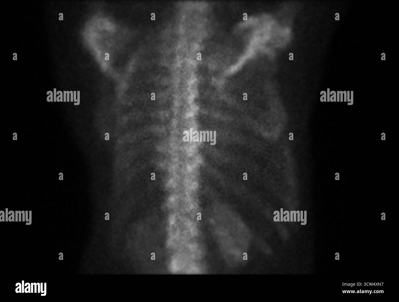 La scansione ossea dell'intero corpo è stata eseguita dopo l'iniezione endovenosa di TC-99m MDP, senza evidenza definitiva di metastasi ossee. Foto Stock
